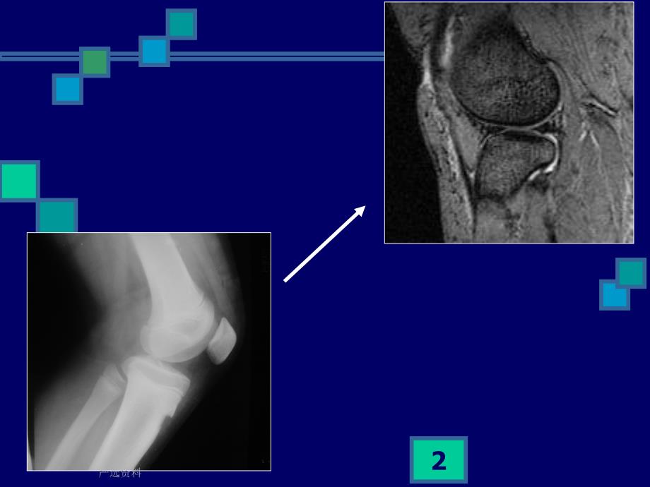 膝关节MRI影像表现（行业荟萃）_第2页