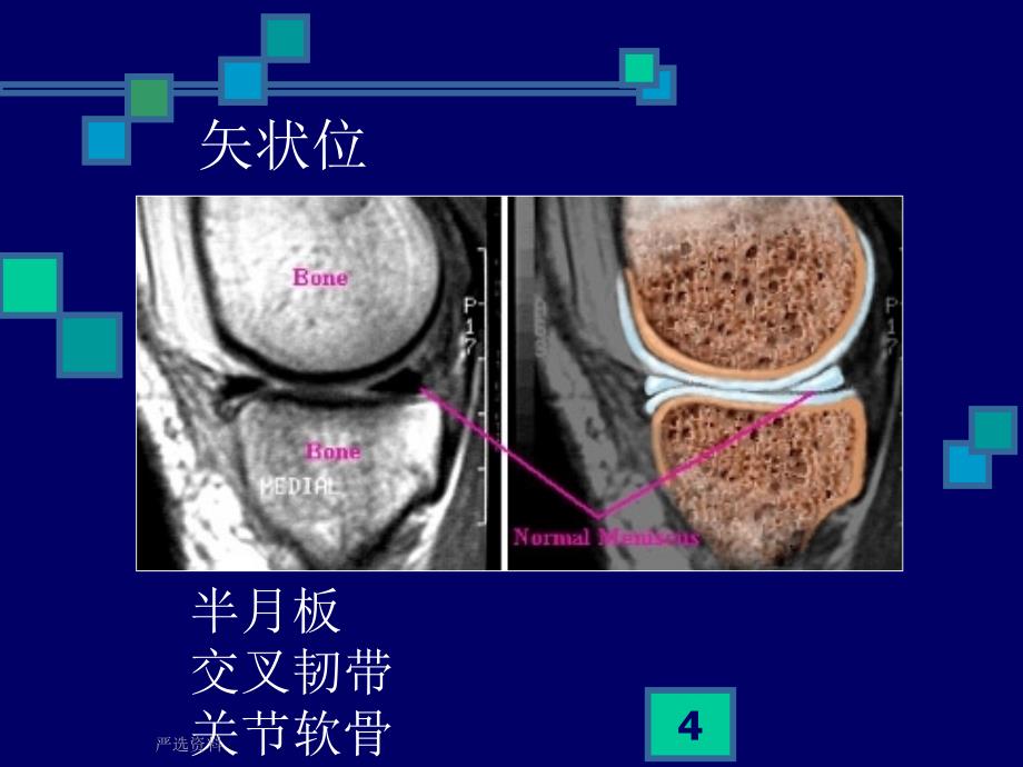 膝关节MRI影像表现（行业荟萃）_第4页