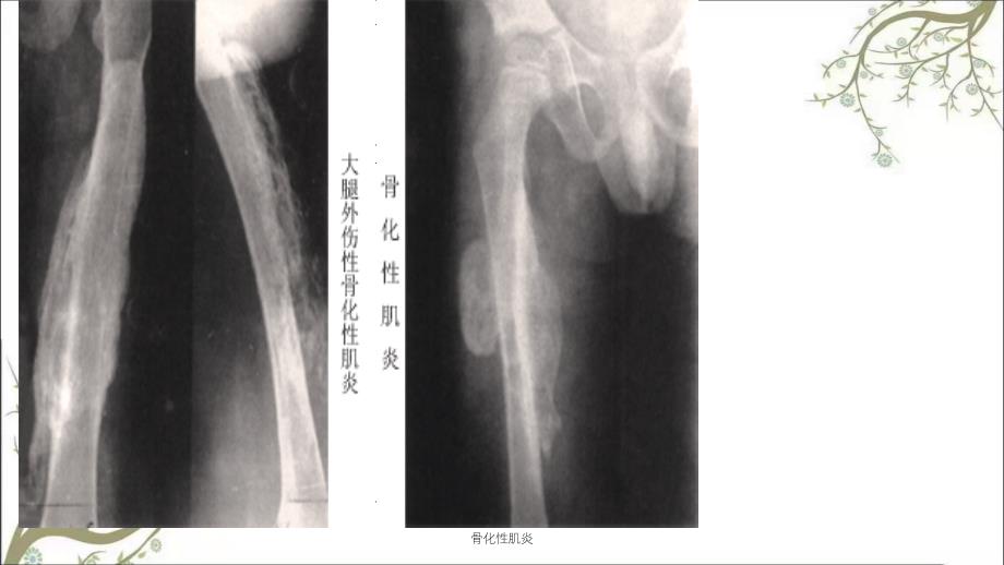 骨化性肌炎课件_第4页