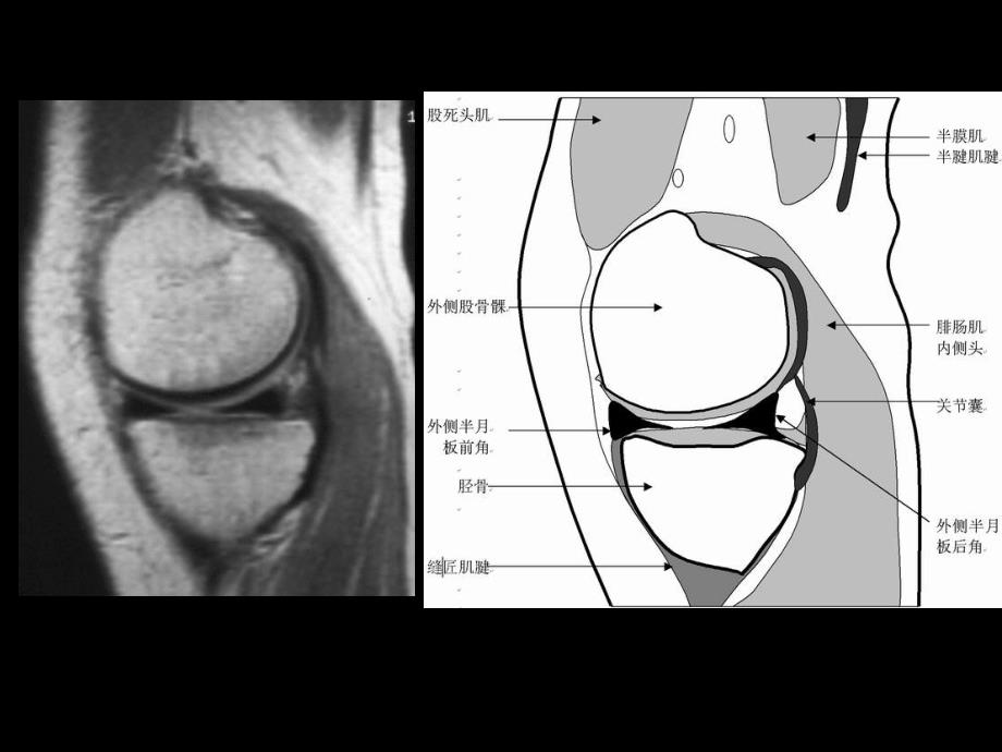 半月板与韧带核磁共振诊断课件文档资料_第3页