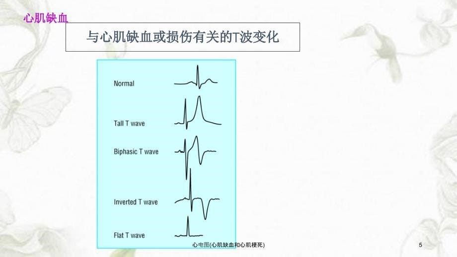 心电图心肌缺血和心肌梗死课件_第5页