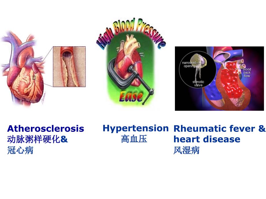 病理学课件：7.心血管系统疾病_第2页