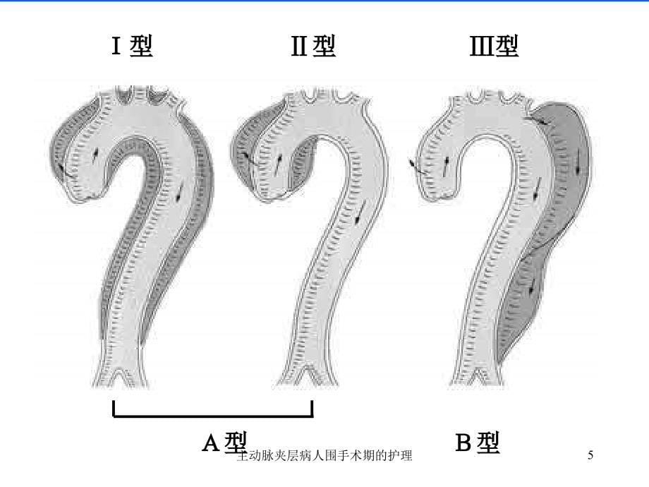 主动脉夹层病人围手术期的护理课件_第5页