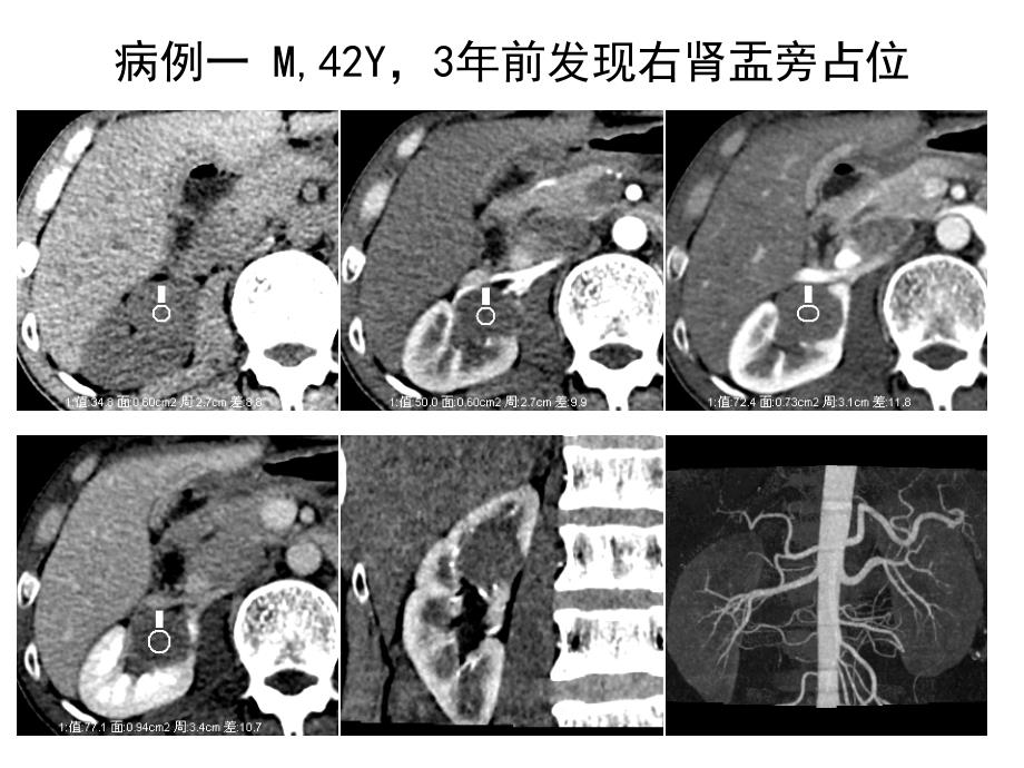 肾脏占位病你例随访ppt课件_第3页