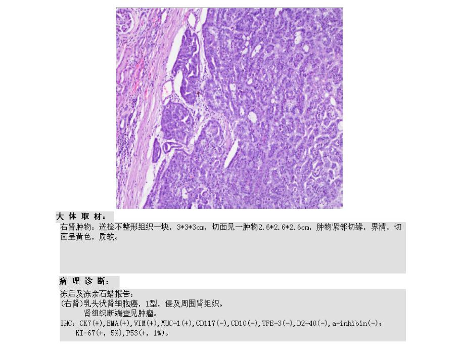 肾脏占位病你例随访ppt课件_第4页