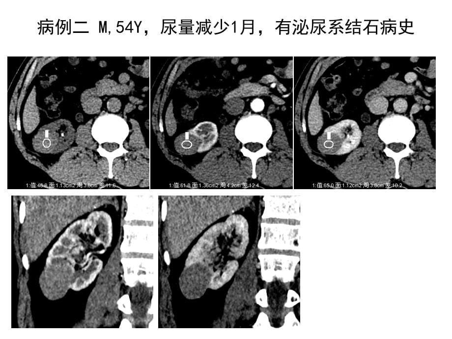 肾脏占位病你例随访ppt课件_第5页