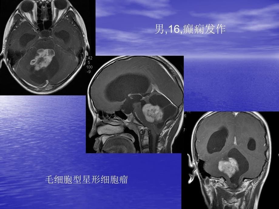 医学课件：脑肿瘤的MRI诊断_第5页