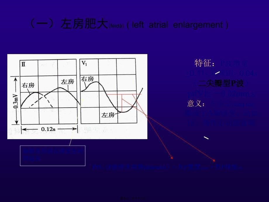 第2讲(12)房室肥大心肌缺血心肌梗塞知识课件_第5页