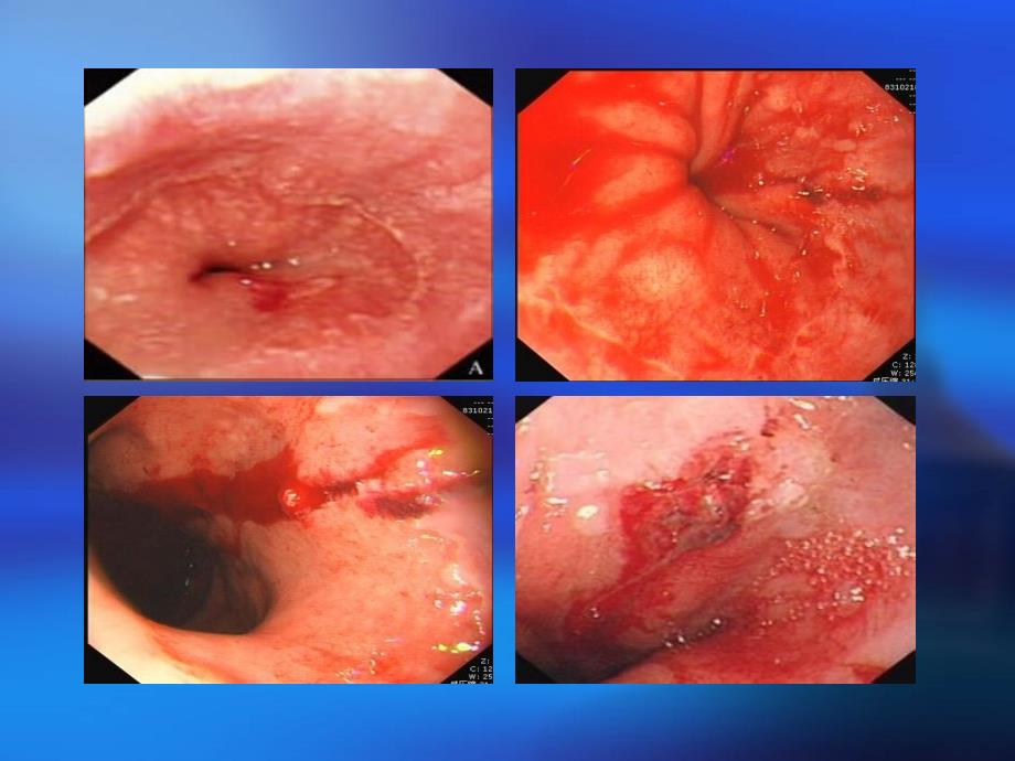 贲门粘膜撕裂课件_第3页