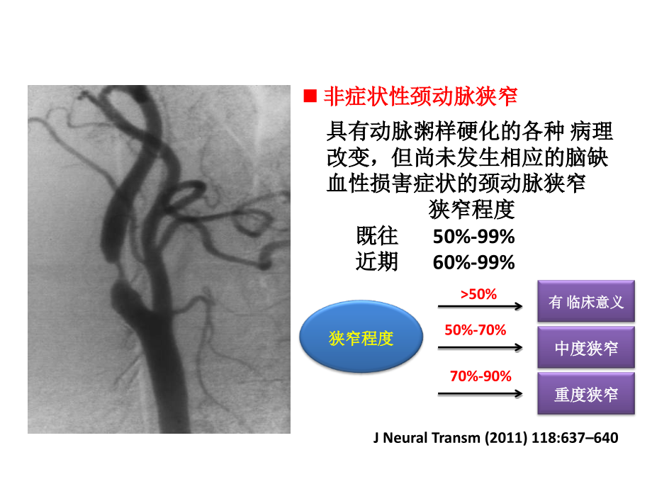 非症状颈动脉狭窄课件_第2页