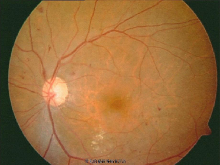 常见的视网膜病变形态课件_第4页