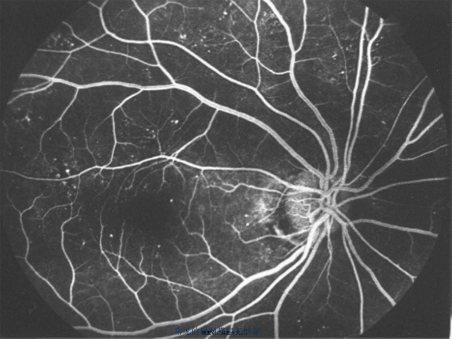 常见的视网膜病变形态课件_第5页