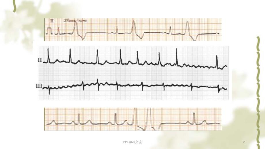常见心律失常的分析课件_第2页
