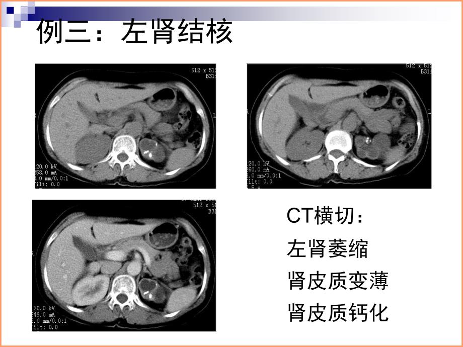 泌尿系结核典型病例影像资料讲课讲稿_第3页