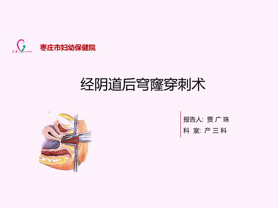 经后穹窿穿刺术PPT课件.ppt_第1页