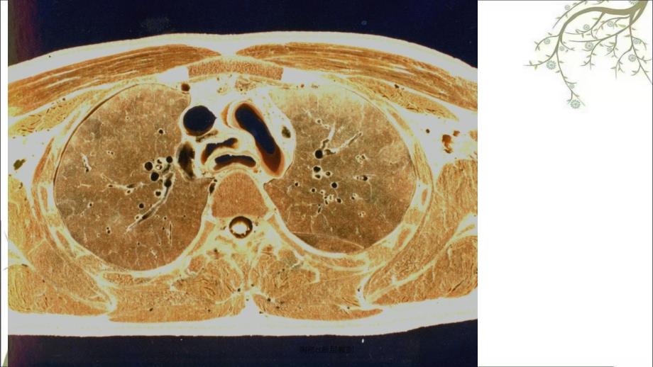 胸部ct断层解剖_第4页
