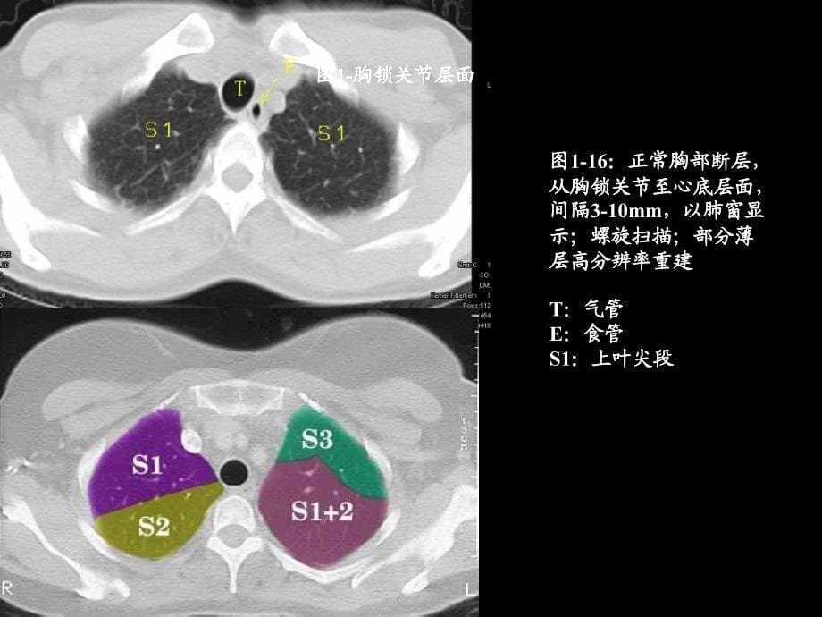 肺部及纵隔ct断层解剖_第5页