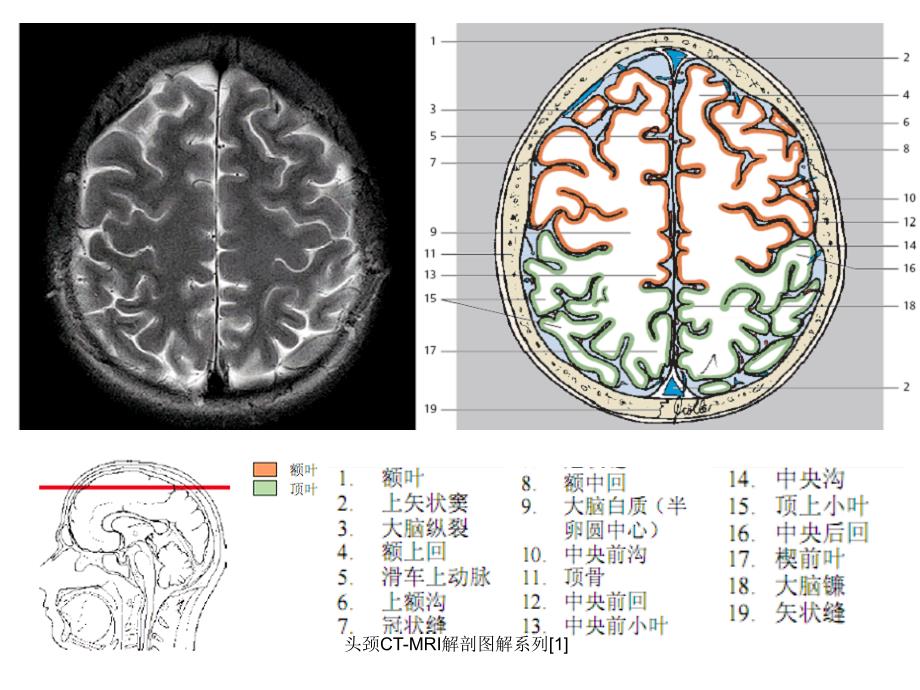 头颈CTMRI解剖图解系列1课件_第3页