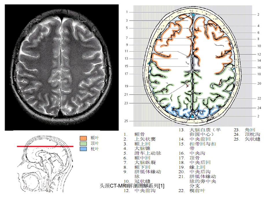 头颈CTMRI解剖图解系列1课件_第4页