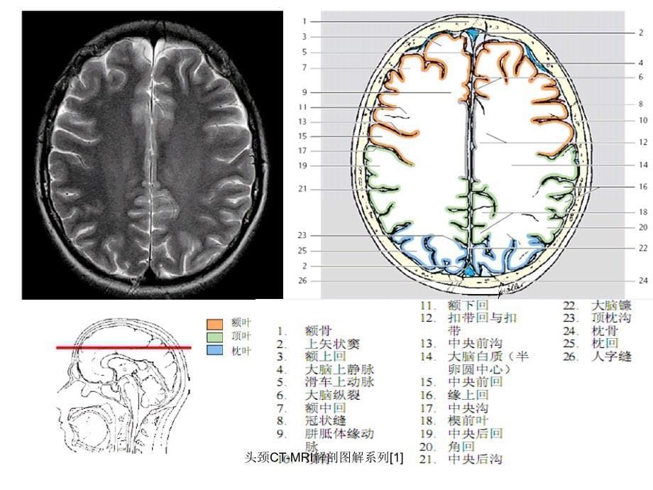 头颈CTMRI解剖图解系列1课件_第5页