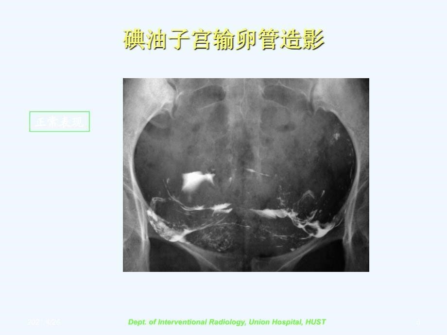 选择性输卵管造影和再通术 课件_第5页