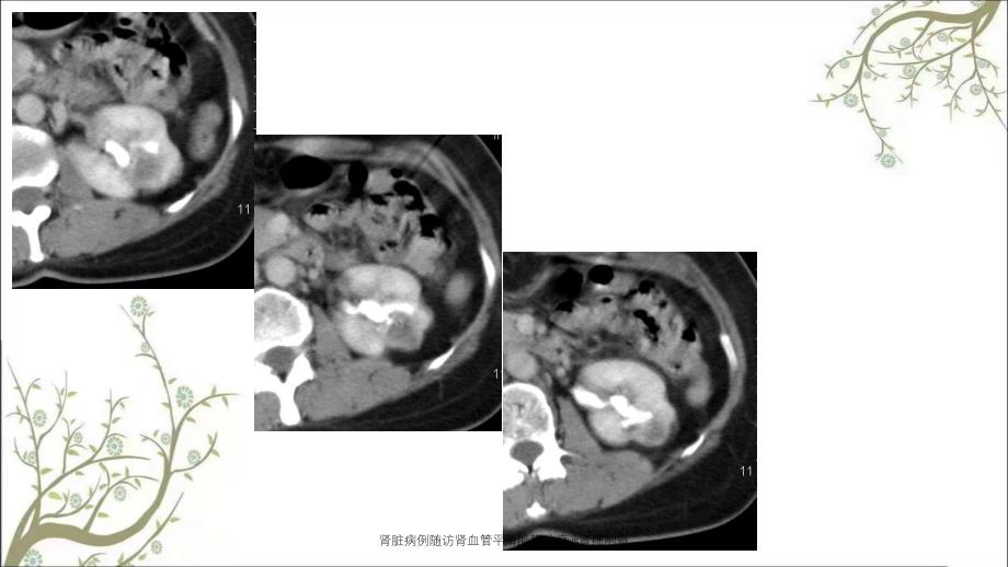 肾脏病例随访肾血管平滑肌脂肪瘤vs肾细胞癌_第4页