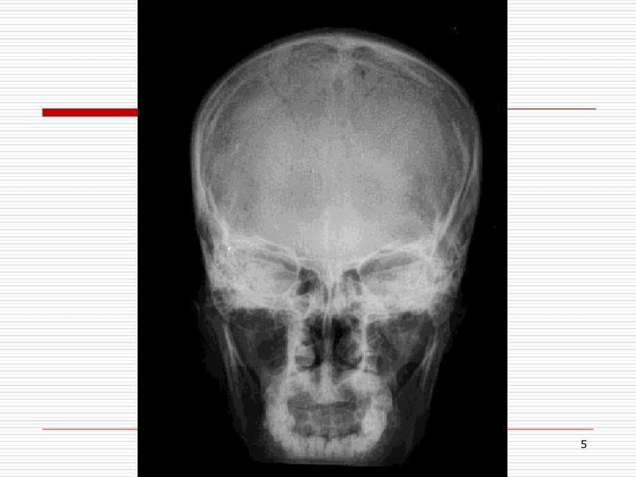 中枢神经系统的放射诊断参考PPT_第5页