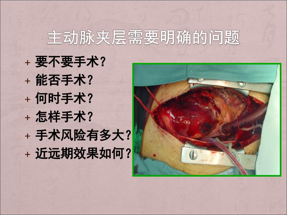 主动脉夹层的外科分型及治疗对策_第4页