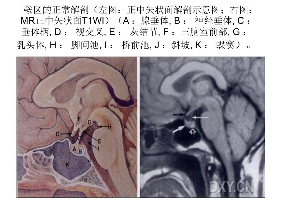 鞍区解剖及病变的MR改变_第2页