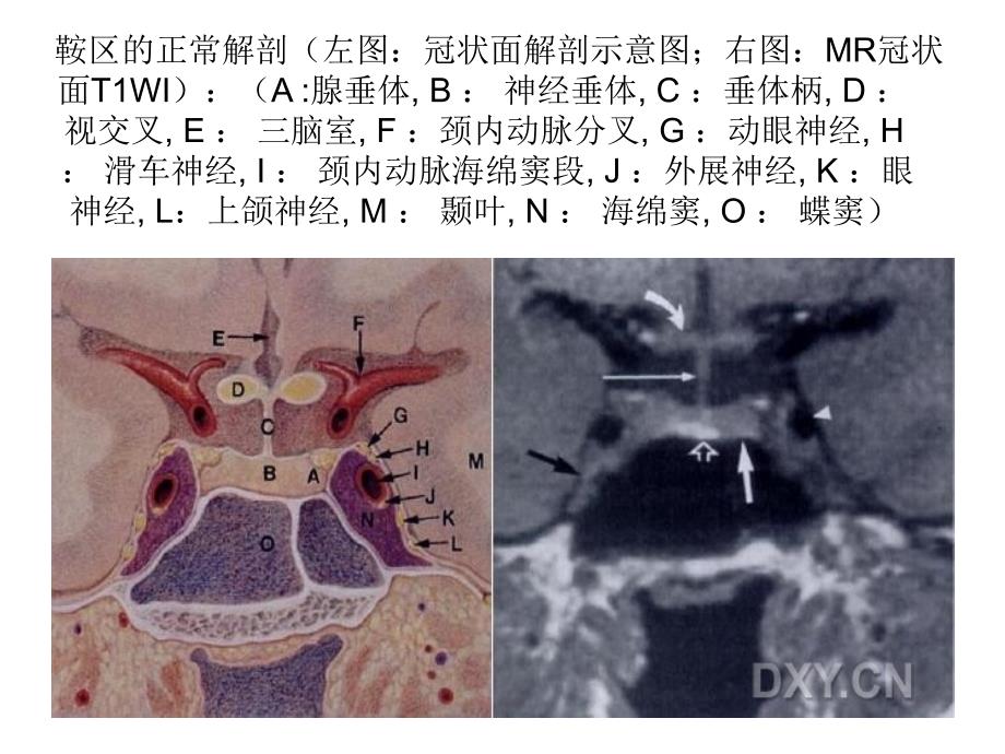 鞍区解剖及病变的MR改变_第3页