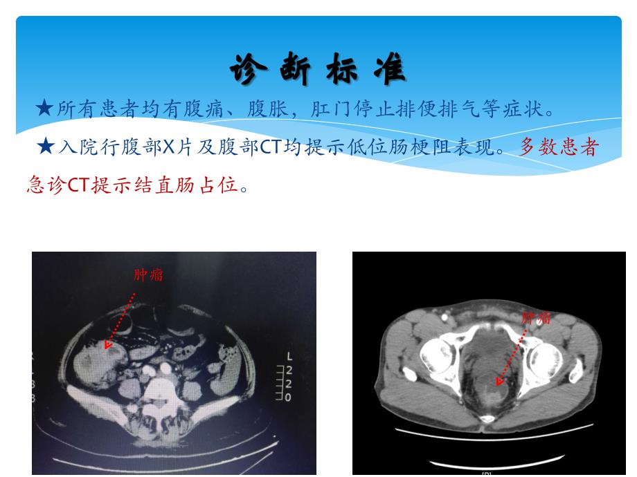 老年大肠癌致急性肠梗阻ppt课件_第4页