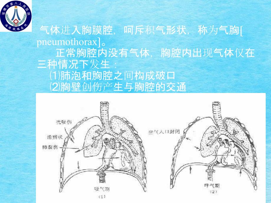 胸腔闭式引流术ppt课件_第4页