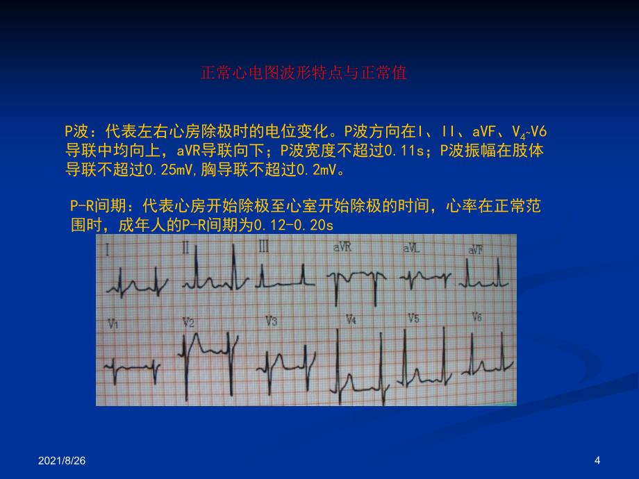 各种心电图表现课件PPT_第4页