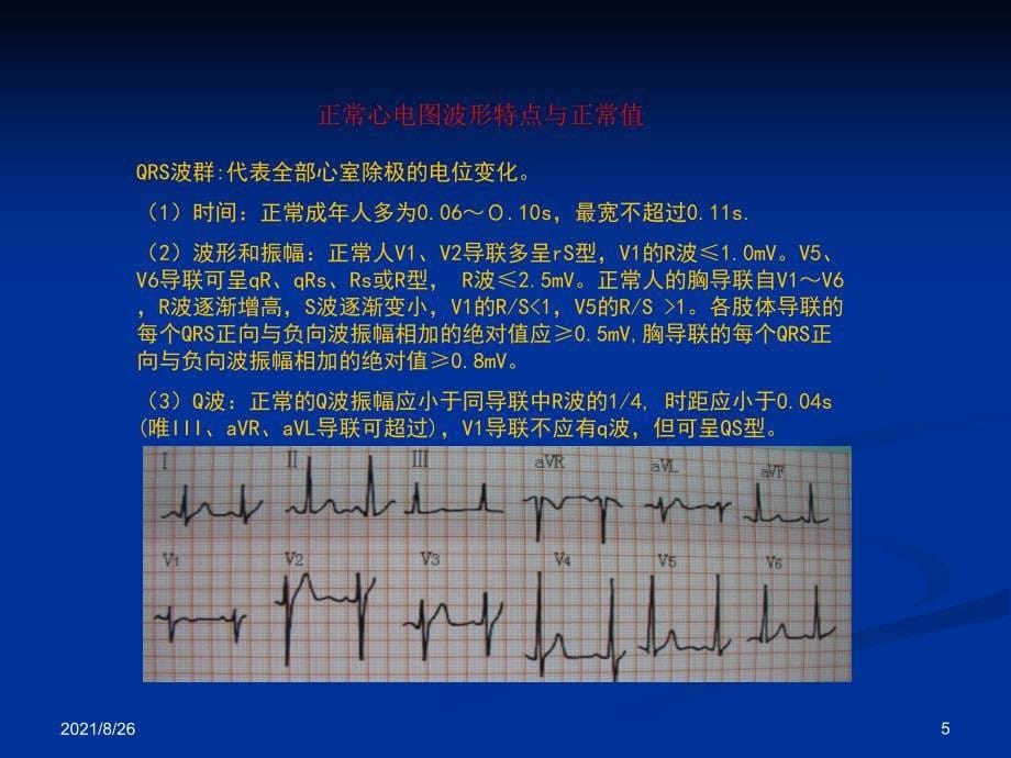 各种心电图表现课件PPT_第5页