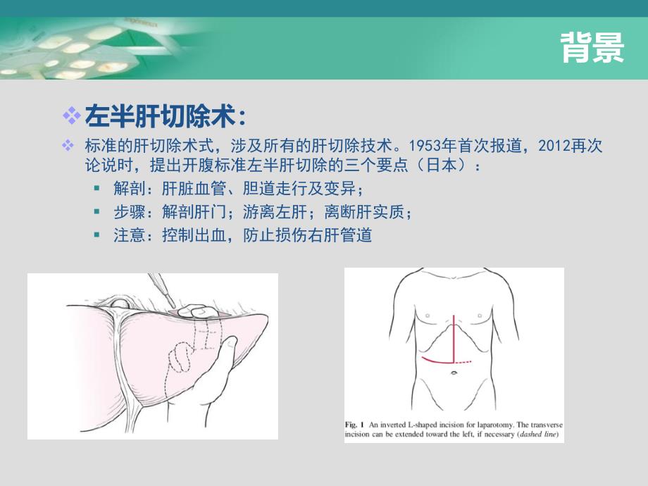 腹腔镜下解剖性左半肝切除术讲义_第3页