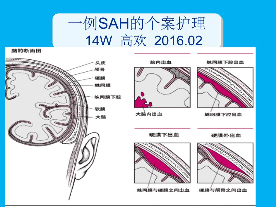 蛛网膜下腔出血的个案护理最终_第1页