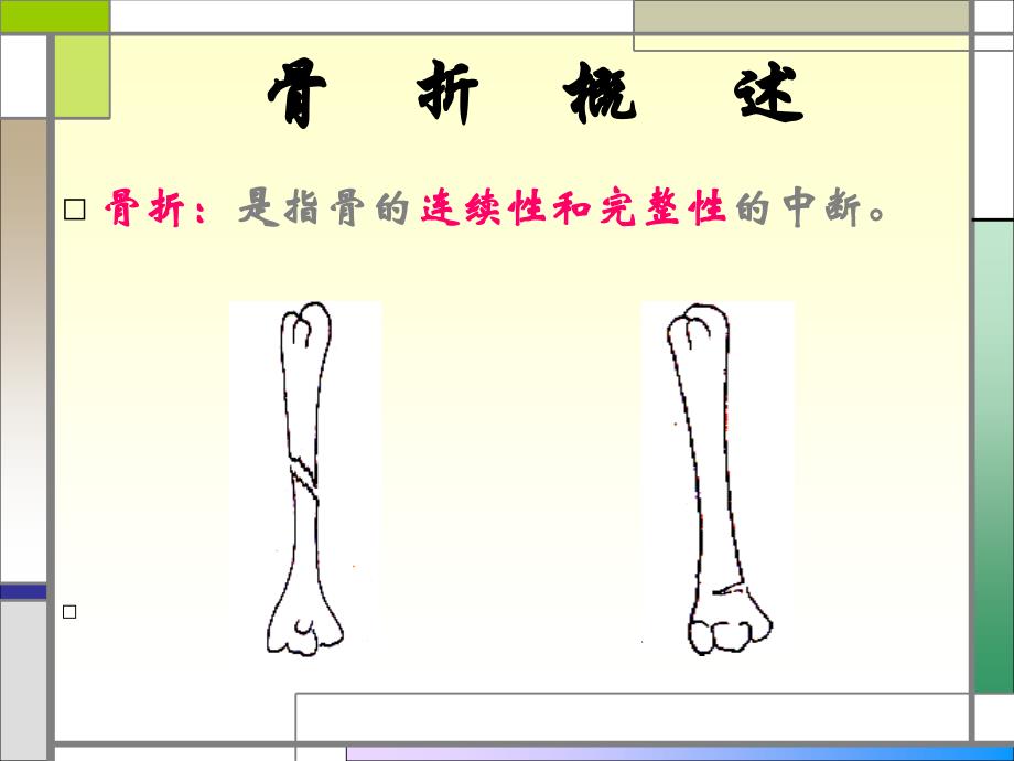 四肢骨折病人的护理ppt课件_第2页