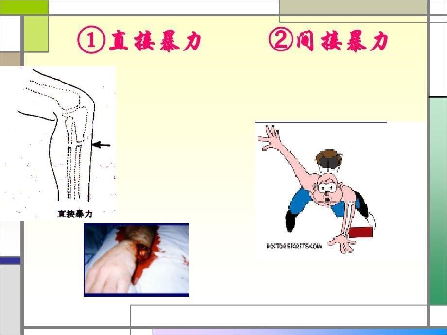 四肢骨折病人的护理ppt课件_第5页