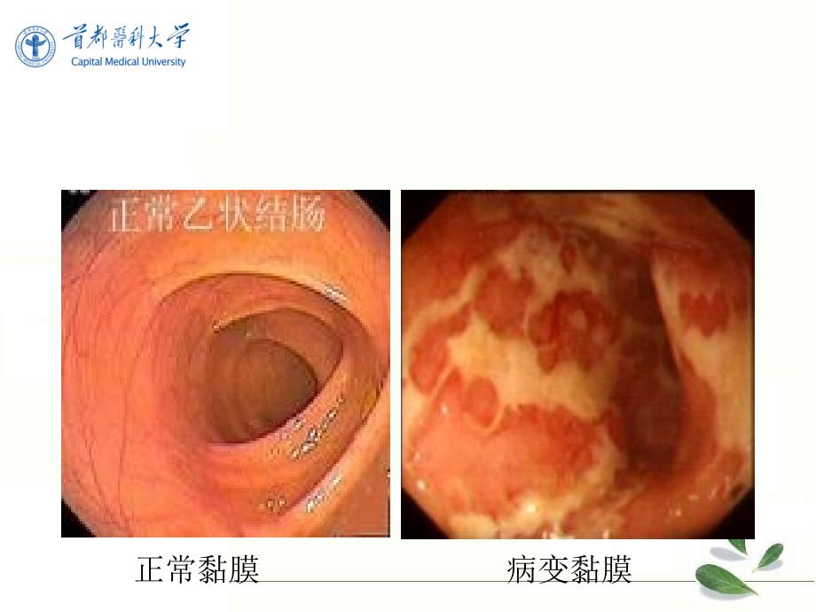 内科医学课件：溃疡性结肠炎_第3页