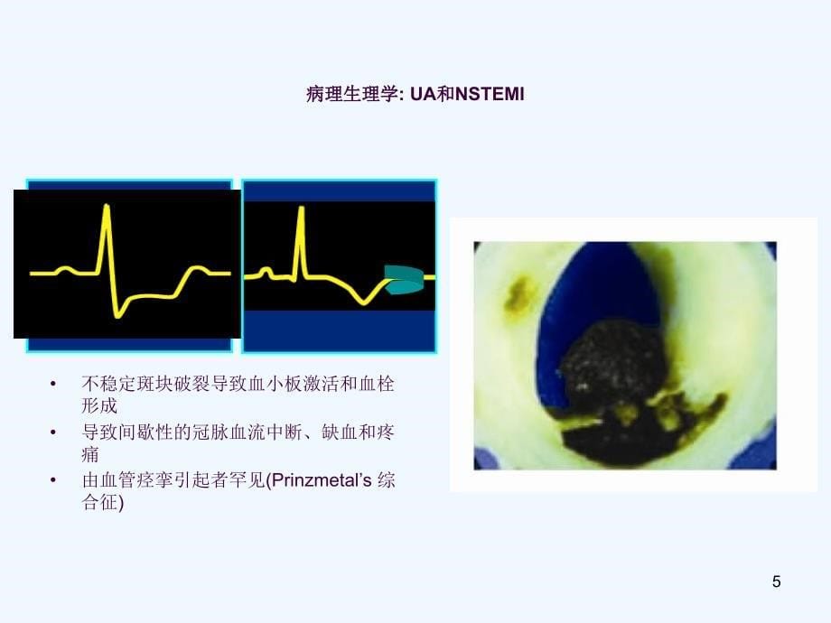 急性冠脉综合征的治疗策略ppt课件_第5页