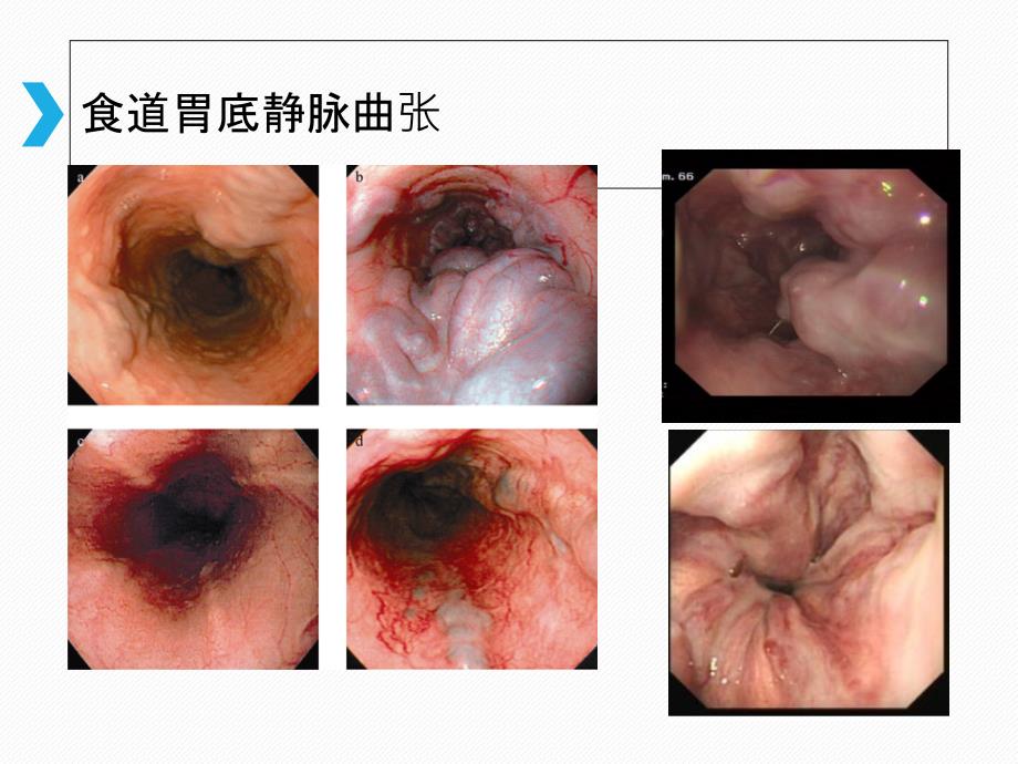 食管胃底静脉曲张出血_第4页