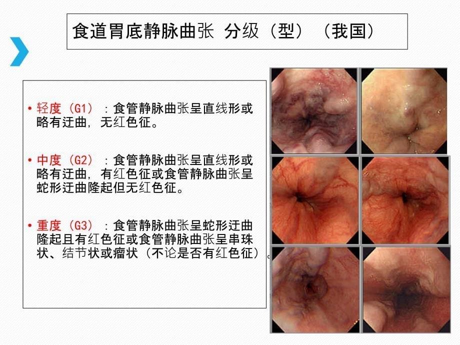 食管胃底静脉曲张出血_第5页