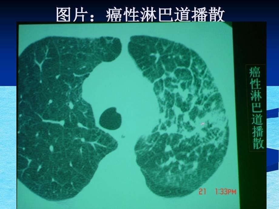 肺部HRCT十大常见征象分析ppt课件_第5页