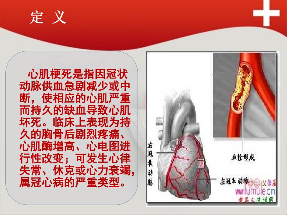 急性心梗的诊断及护理课件_第4页