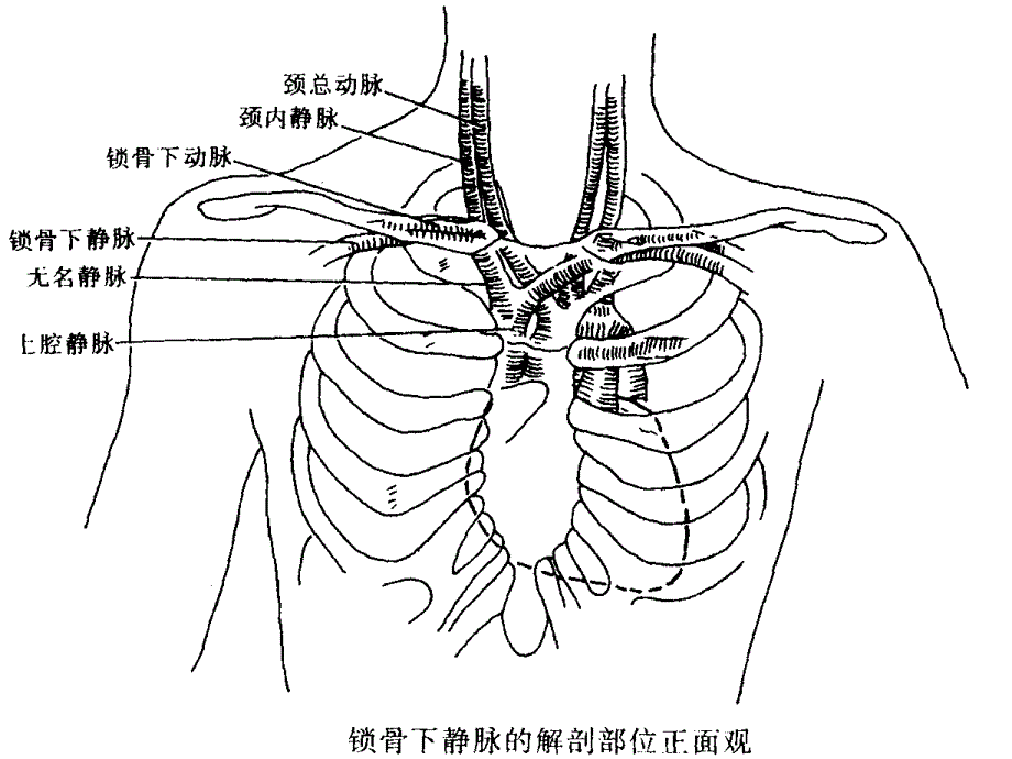 锁骨下静脉穿刺置管手术课件_第3页