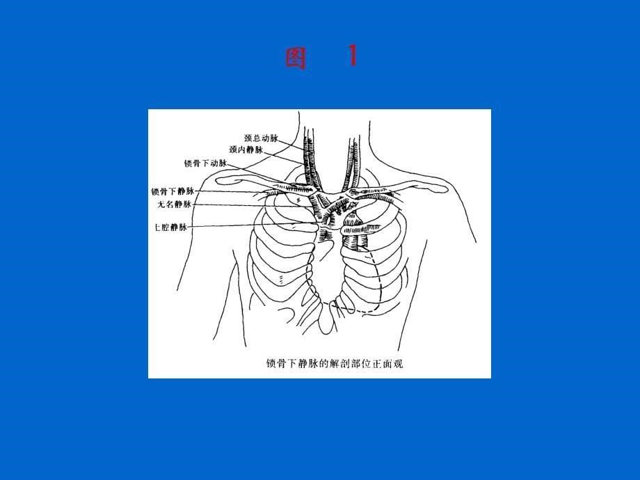 锁骨下静脉穿刺置管手术课件_第5页