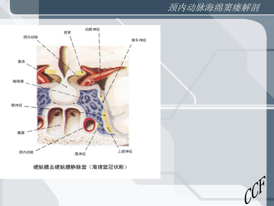 颈内动脉海绵窦瘘.ppt_第3页