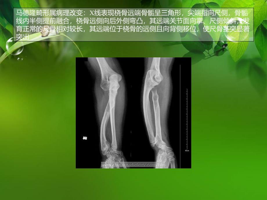 骨肌部分正常变异课件_第3页