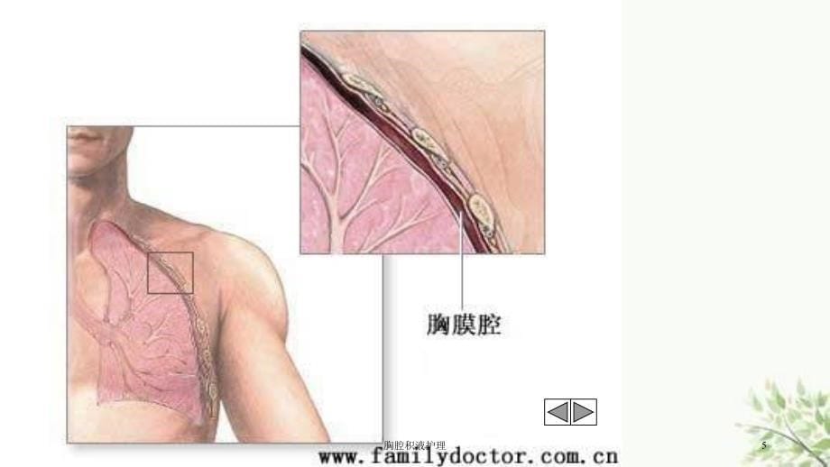 胸腔积液护理课件_第5页