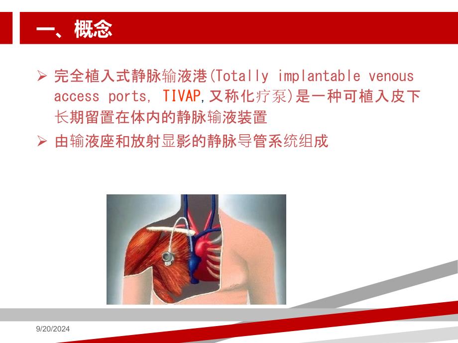 输液港的护理课件_第3页